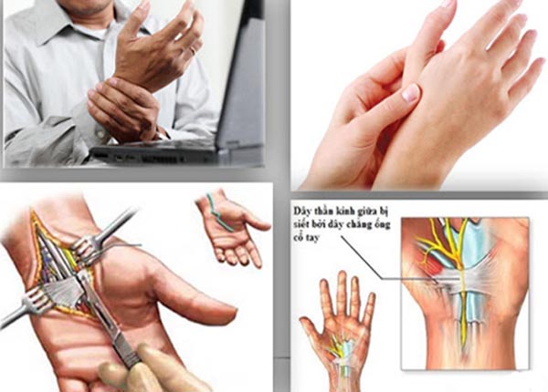 Bệnh nhân cần lưu ý những biểu hiện triệu chứng của hội chứng ống cổ tay