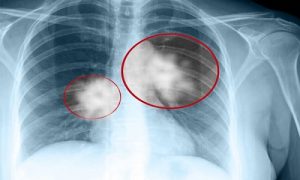 Chụp X quang lồng ngực chuẩn đoán ung thư vòm họng