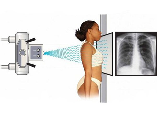 Chụp X-quang tim phổi thẳng