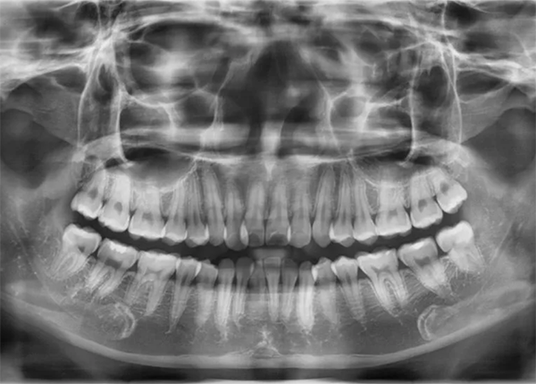 Hình ảnh X quang răng cận chóp