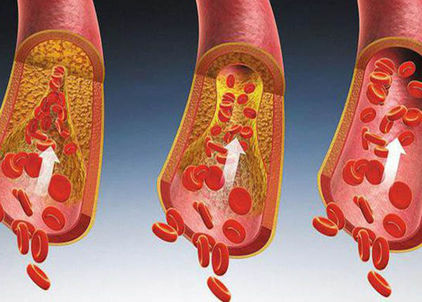 Những hành vi vô thường khiến mạch máu bị giảm tuổi thọ