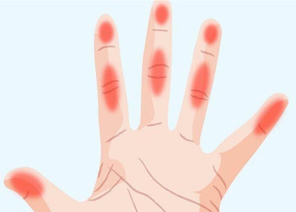 Triệu chứng thường gặp nhất là các ngón tay bị đau nhức sau khi thức dậy