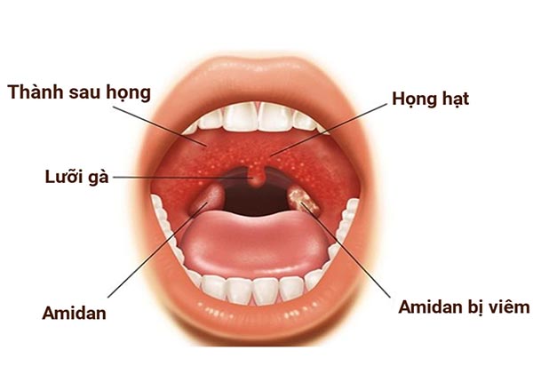 Viêm họng là một dạng bệnh viêm nhiễm trùng phổ biến