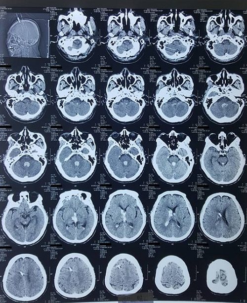 Hình ảnh Y học – Phim chụp cắt lớp vi tính sọ não