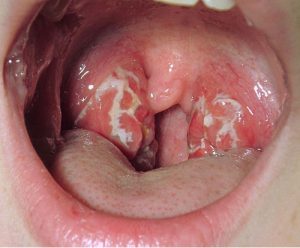 Chẩn đoán ung thư vòm họng bằng việc chụp X- quang