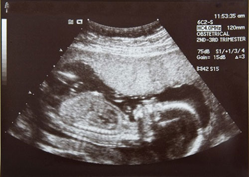 Chẩn đoán hình ảnh giới tính thai nhi dưới 20 tuần tuổi có chính xác?