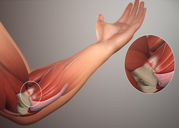 Đau khớp khuỷu tay ảnh hưởng khả năng vận động cánh tay của người bệnh